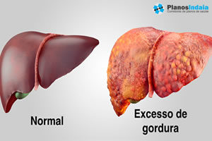 Gordura no Fígado: Causas e Tratamentos
